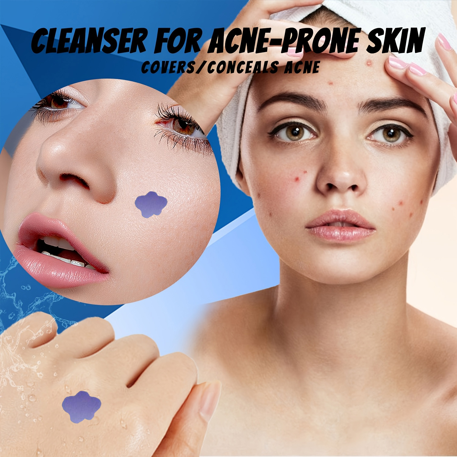 Patchs Microneedle Anti-Acné 2 - Skincare avis et prix