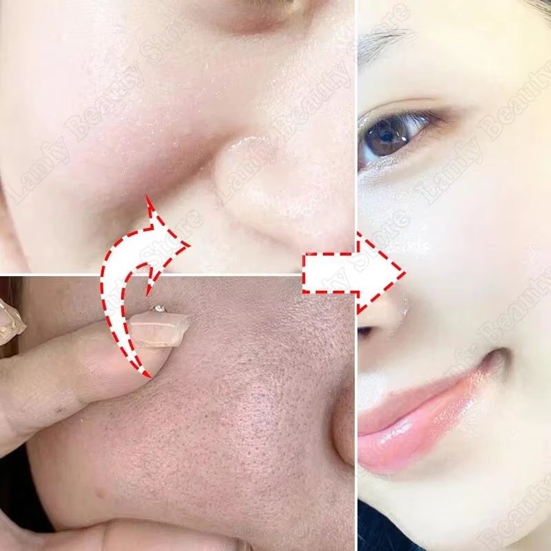 Crème Nettoyante pour les Pore - Salicylic Acid Blackhead Remover avis et prix