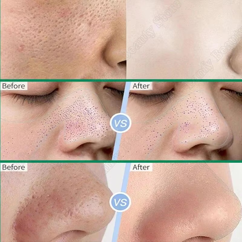 Crème Nettoyante pour les Pore - Salicylic Acid Blackhead Remover avis et prix